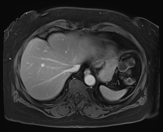 Adrenal cortical carcinoma (Radiopaedia 64017-72770 J 8).jpg
