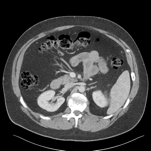 Adrenal cyst (Radiopaedia 45625-49777 Axial C+ portal venous phase 41).png