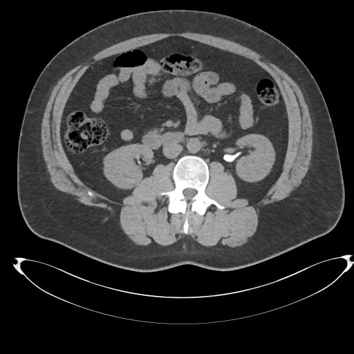 Adrenal cyst (Radiopaedia 45625-49778 Axial non-contrast 59).png