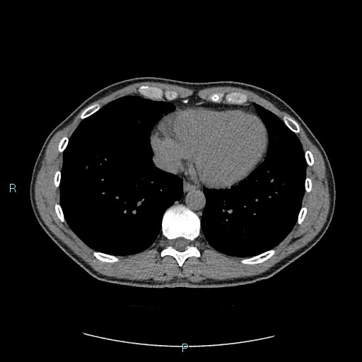 Adrenal cystic lymphangioma (Radiopaedia 83161-97534 Axial non-contrast 6).jpg