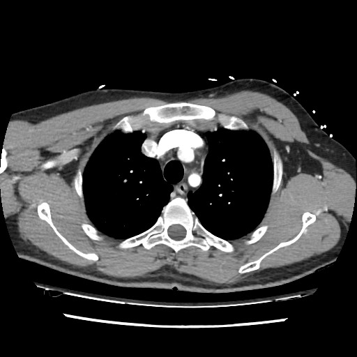 Adrenal gland trauma (Radiopaedia 81351-95078 Axial Dual bolus trauma C+ 21).jpg