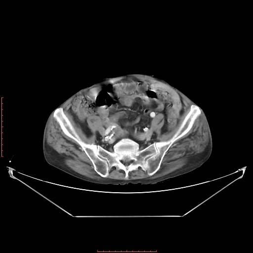 File:Adrenal hemangioma (Radiopaedia 68923-78668 Axial C+ portal venous phase 54).jpg