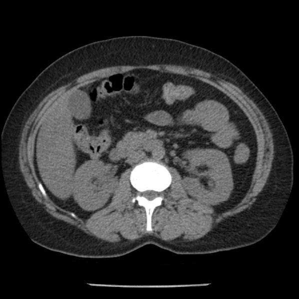 Adrenal myelolipoma (Radiopaedia 43401-46759 Axial non-contrast 38).jpg