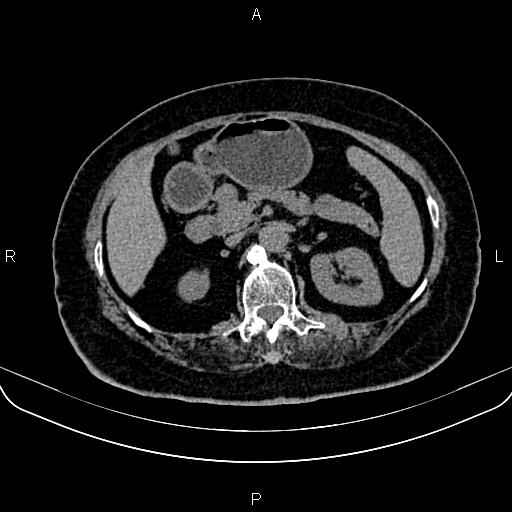 Adrenal myelolipoma (Radiopaedia 82742-96986 Axial non-contrast 56).jpg