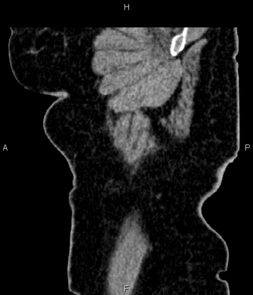 Adrenal myelolipoma (Radiopaedia 82742-96986 Sagittal renal cortical phase 12).jpg