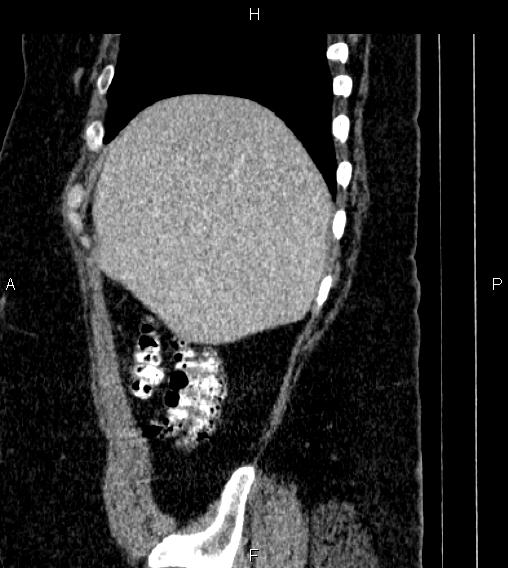 Adrenal myelolipoma (Radiopaedia 84319-99617 Sagittal renal cortical phase 14).jpg