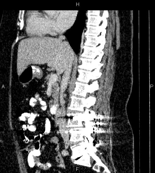 Adrenal myelolipoma (Radiopaedia 84319-99617 Sagittal renal cortical phase 44).jpg