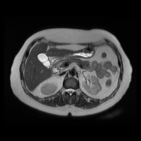 File:Adrenal myelolipoma - MRI (Radiopaedia 83249-97646 Axial T2 17).jpg