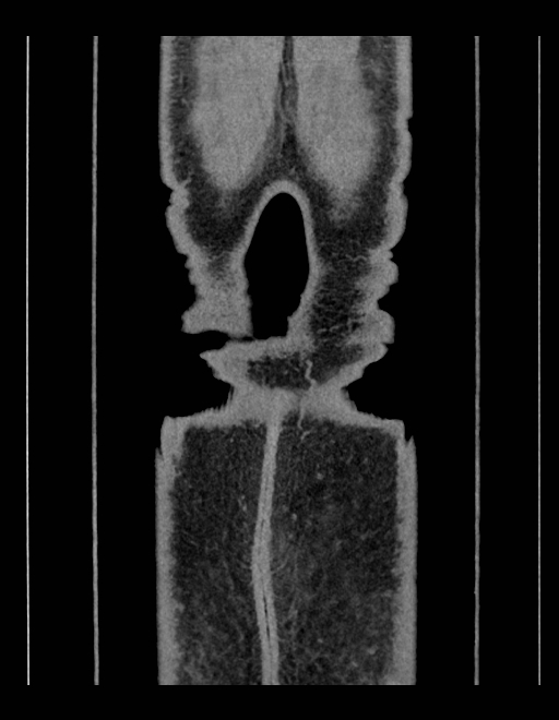 Adrenal myelolipoma - bilateral (Radiopaedia 74805-85810 Coronal C+ portal venous phase 31).jpg