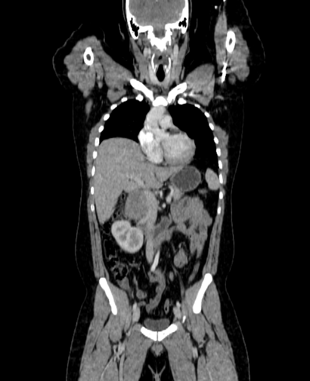 Adrenocortical carcinoma (Radiopaedia 80134-93438 Coronal C+ portal venous phase 73).jpg