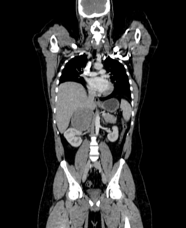 Adrenocortical carcinoma (Radiopaedia 80134-93438 Coronal C+ portal venous phase 90).jpg