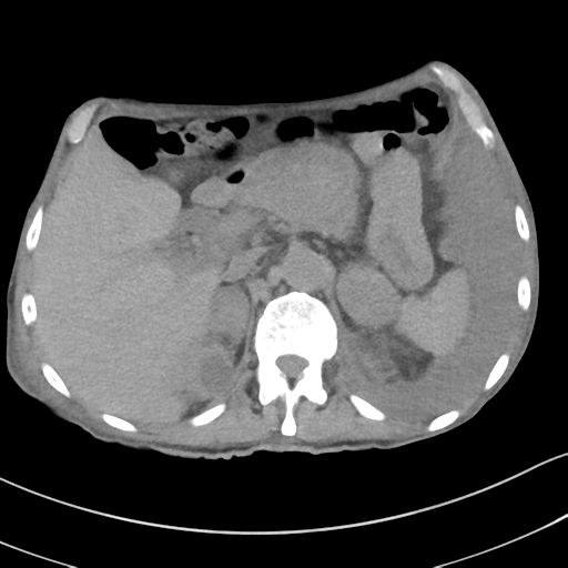 Advanced metastatic lung cancer (Radiopaedia 48910-53954 Axial non-contrast 61).png