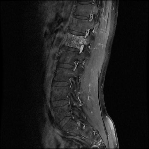 File:Aggressive vertebral hemangioma with pathological fracture (Radiopaedia 69528-79411 F 8).jpg
