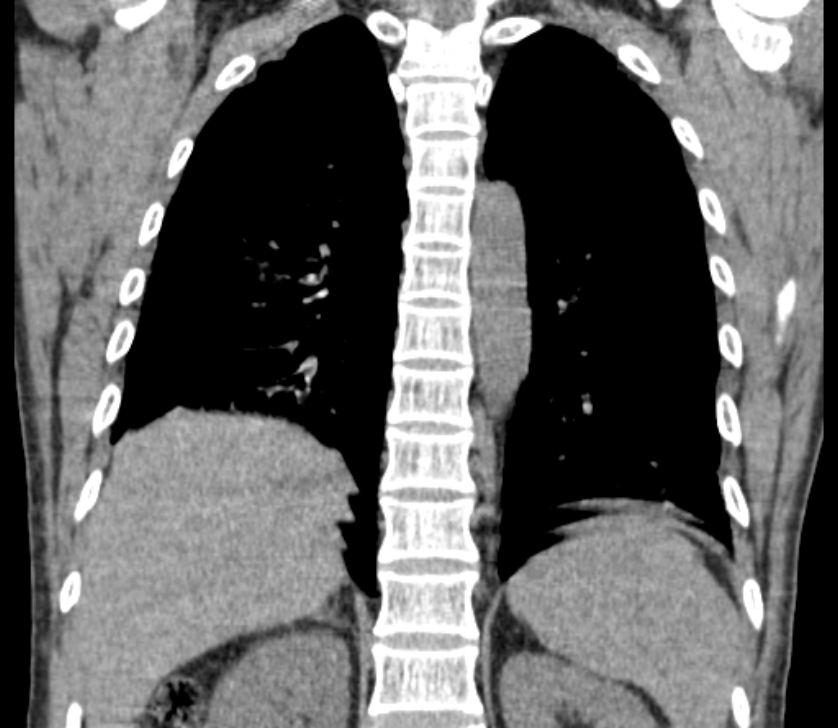 Airway foreign body in adult (Radiopaedia 85907-101779 Coronal liver window 192).jpg