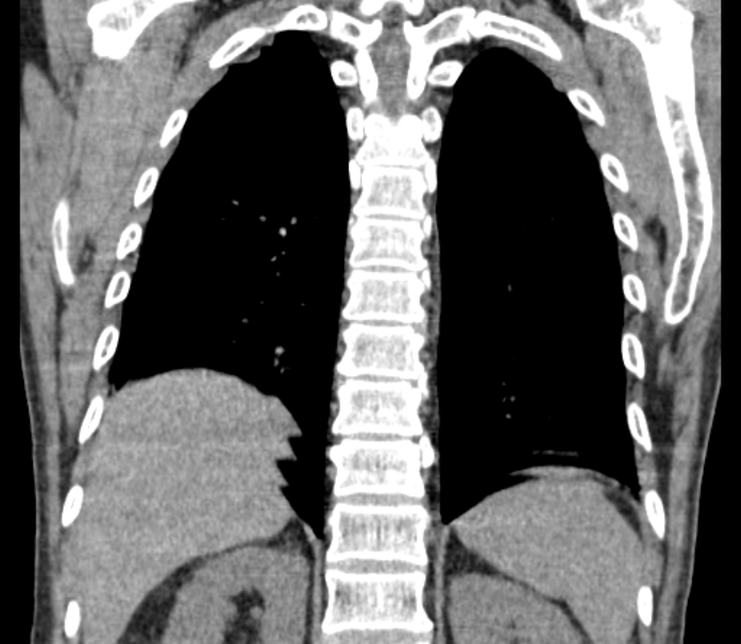 Airway foreign body in adult (Radiopaedia 85907-101779 Coronal liver window 208).jpg