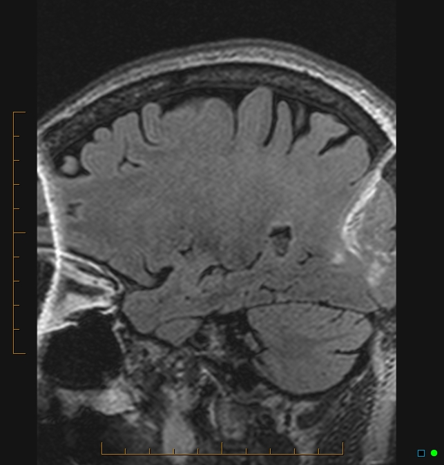 Aliasing artifact causing a spurious cerebellar lesion (Radiopaedia 48783-53810 Sagittal FLAIR 86).jpg