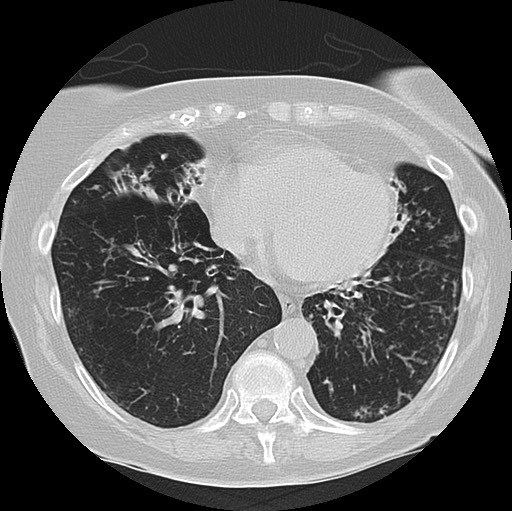 Alpha-1-antitrypsin deficiency (Radiopaedia 72058-82557 Axial lung window 49).jpg
