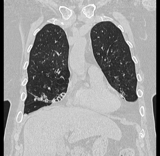 Alpha-1-antitrypsin deficiency (Radiopaedia 72058-82557 Coronal lung window 14).jpg