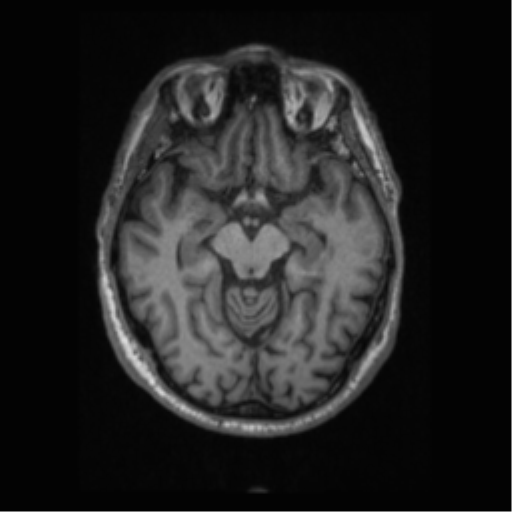 Alzheimer disease - probable (Radiopaedia 35334-36837 Axial T1 33).png