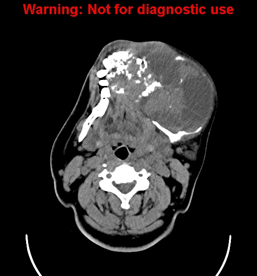 File:Ameloblastoma (Radiopaedia 33126-34164 A 12).jpg