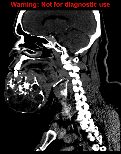Ameloblastoma (Radiopaedia 33126-34164 F 33).jpg