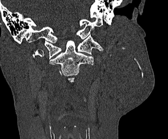 Ameloblastoma (Radiopaedia 51921-57766 Coronal bone window 219).jpg