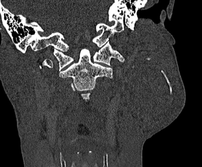 Ameloblastoma (Radiopaedia 51921-57766 Coronal bone window 220).jpg