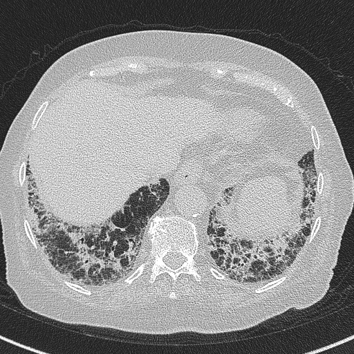 Amiodarone-induced pulmonary fibrosis (Radiopaedia 82355-96460 Axial lung window 57).jpg