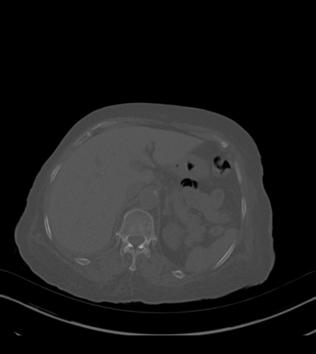 Amiodarone deposition in the liver (Radiopaedia 77587-89780 Axial bone window 82).jpg