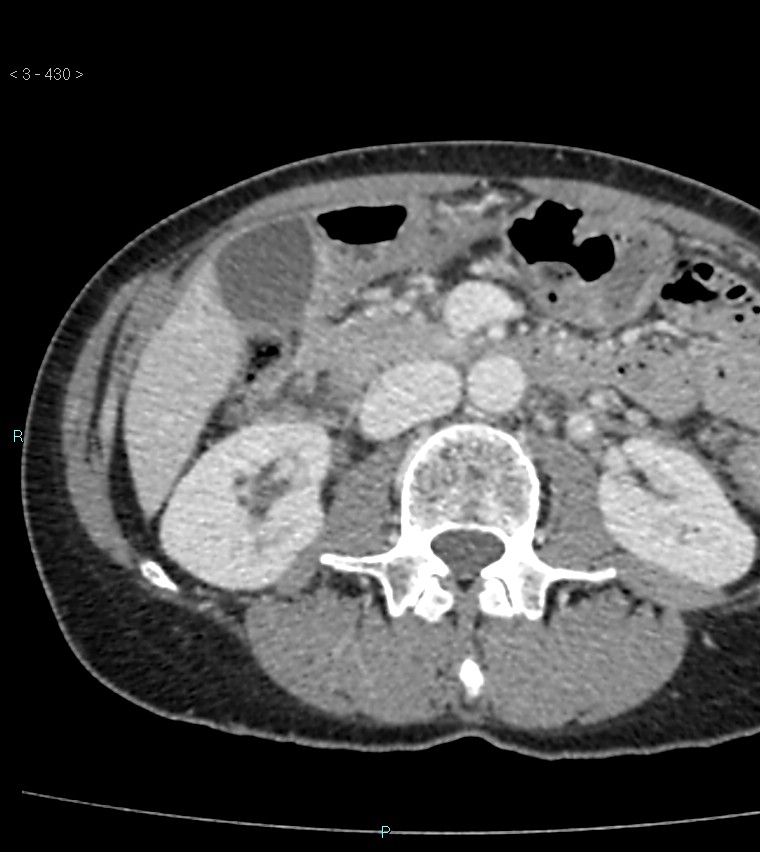 Ampulla of Vater metastasis (Radiopaedia 27820-28065 A 34).jpg