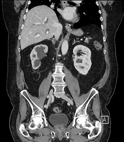 Ampullary adenocarcinoma (Radiopaedia 59373-66734 D 64).jpg