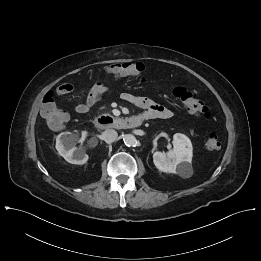 Ampullary adenocarcinoma (Radiopaedia 59373-66737 A 72).jpg