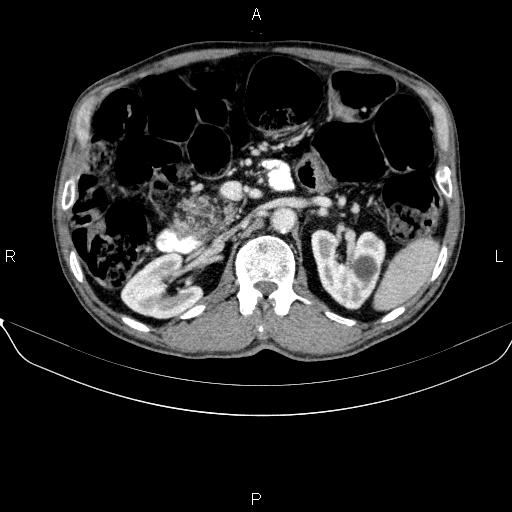 Ampullary adenocarcinoma (Radiopaedia 86093-102032 A 23).jpg