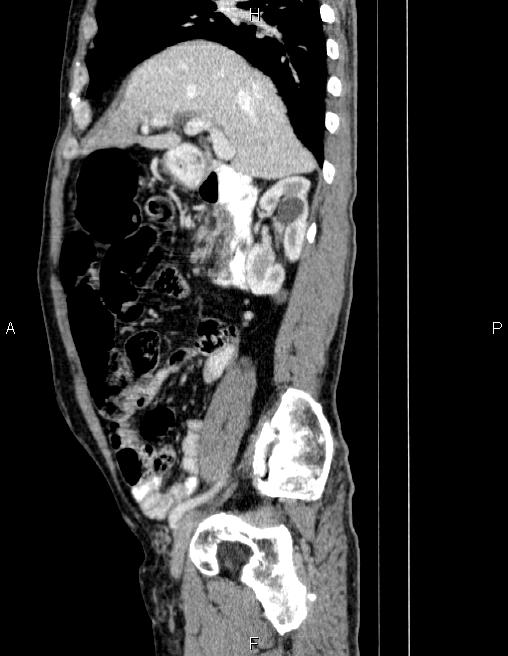 Ampullary adenocarcinoma (Radiopaedia 86093-102032 D 31).jpg