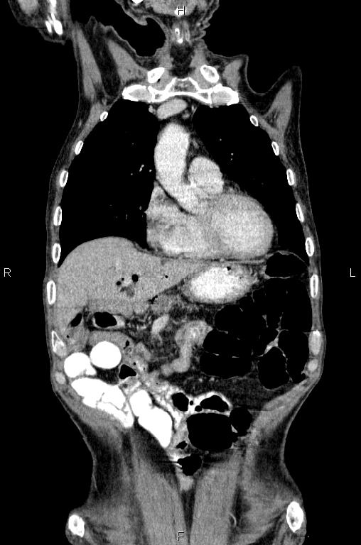 Ampullary adenocarcinoma (Radiopaedia 86093-102033 D 16).jpg