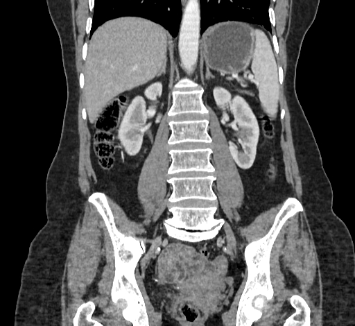 Ampullary tumor (Radiopaedia 60333-67998 B 49).jpg
