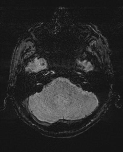 Amyloid angiopathy with inflammation (Radiopaedia 30360-31002 Axial SWI 6).jpg