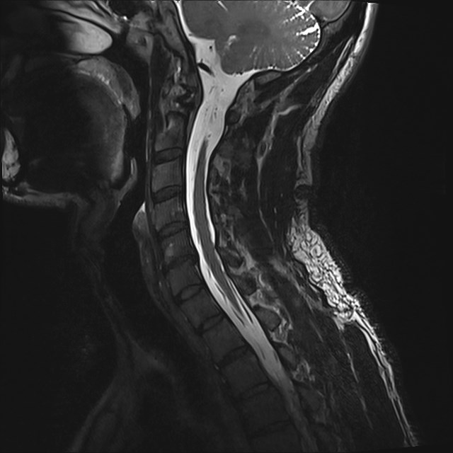 Amyotrophic lateral sclerosis (Radiopaedia 87352-103658 I 38).jpg