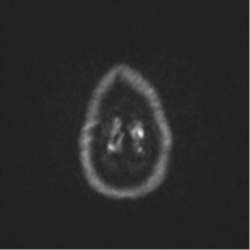 Anaplastic astrocytoma (Radiopaedia 57768-64731 Axial DWI 56).png