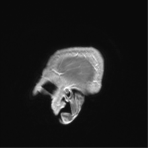 Anaplastic astrocytoma IDH mutant (Radiopaedia 50046-55341 Sagittal T1 C+ 57).png