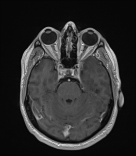 File:Anaplastic astrocytoma IDH wild-type (Radiopaedia 49984-55273 Axial T1 C+ 20).png
