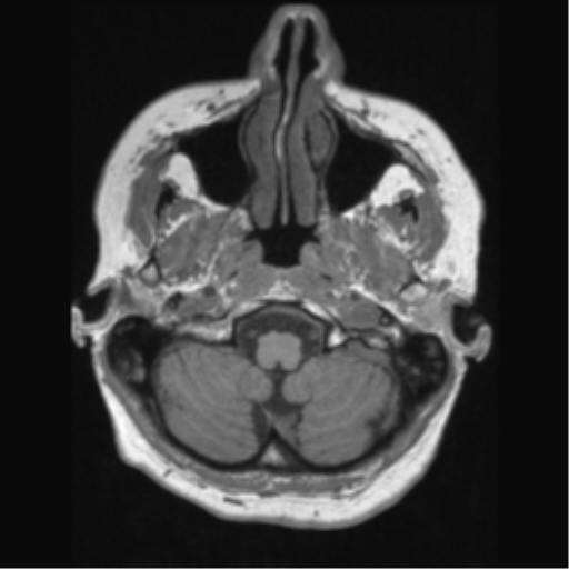 File:Anaplastic astrocytoma IDH wild-type (pseudoprogression) (Radiopaedia 42209-45276 Axial T1 26).png