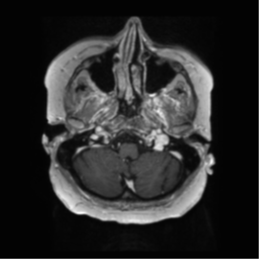 File:Anaplastic astrocytoma IDH wild-type (pseudoprogression) (Radiopaedia 42209-45279 Axial T1 C+ 25).png