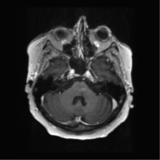 File:Anaplastic astrocytoma IDH wild-type (pseudoprogression) (Radiopaedia 42209-45279 Axial T1 C+ 39).png