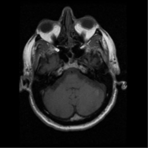 File:Anaplastic meningioma with recurrence (Radiopaedia 34452-35783 Axial T1 4).png