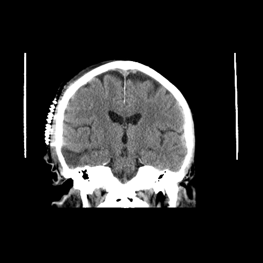 File:Anaplastic meningioma with recurrence (Radiopaedia 34452-35786 Axial non-contrast 1).png