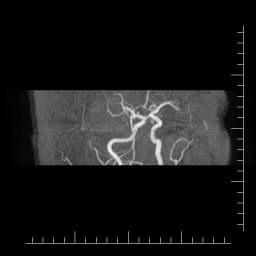 File:Aneurysm of posterior communicating artery (Radiopaedia 20188-20163 MRA 16).jpg