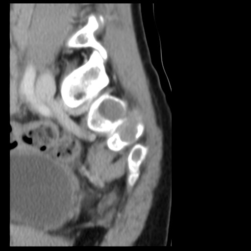 File:Aneurysmal bone cyst - sacrum (Radiopaedia 65190-74195 A 7).jpg