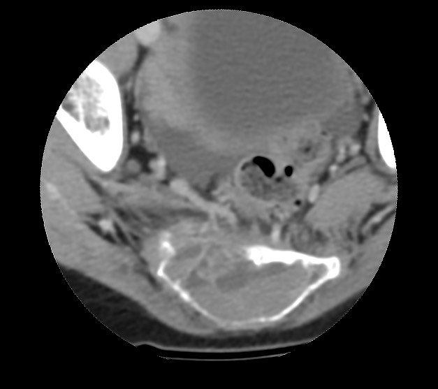 Aneurysmal bone cyst - sacrum (Radiopaedia 65190-74195 Axial non-contrast 33).jpg