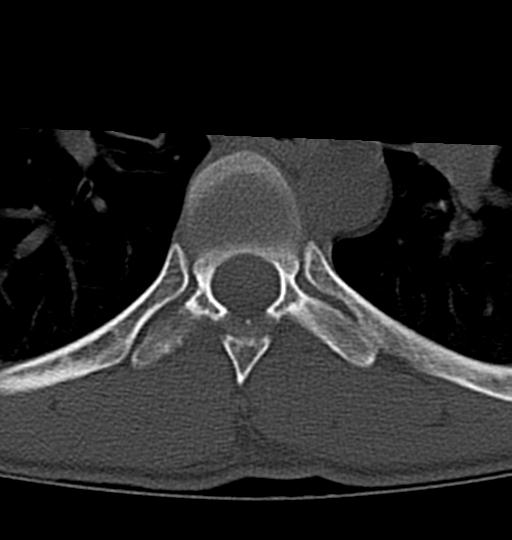 Aneurysmal bone cyst T11 (Radiopaedia 29294-29721 Axial bone window 2).jpg